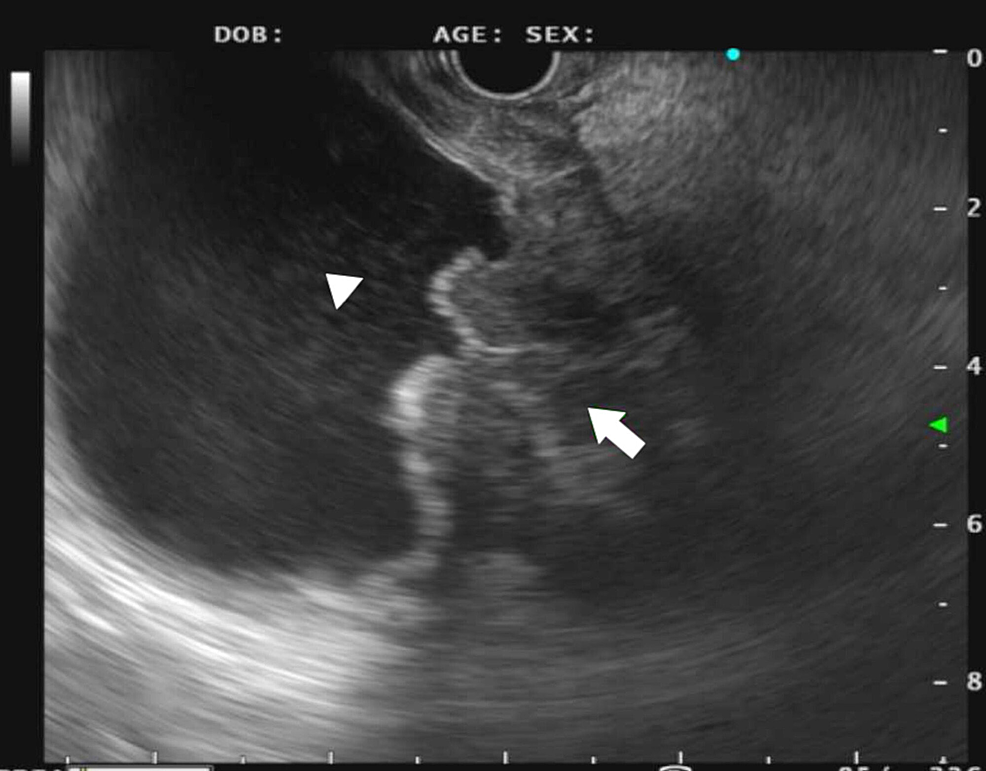Cureus Exploring the Excluded Stomach A Case Series of Novel