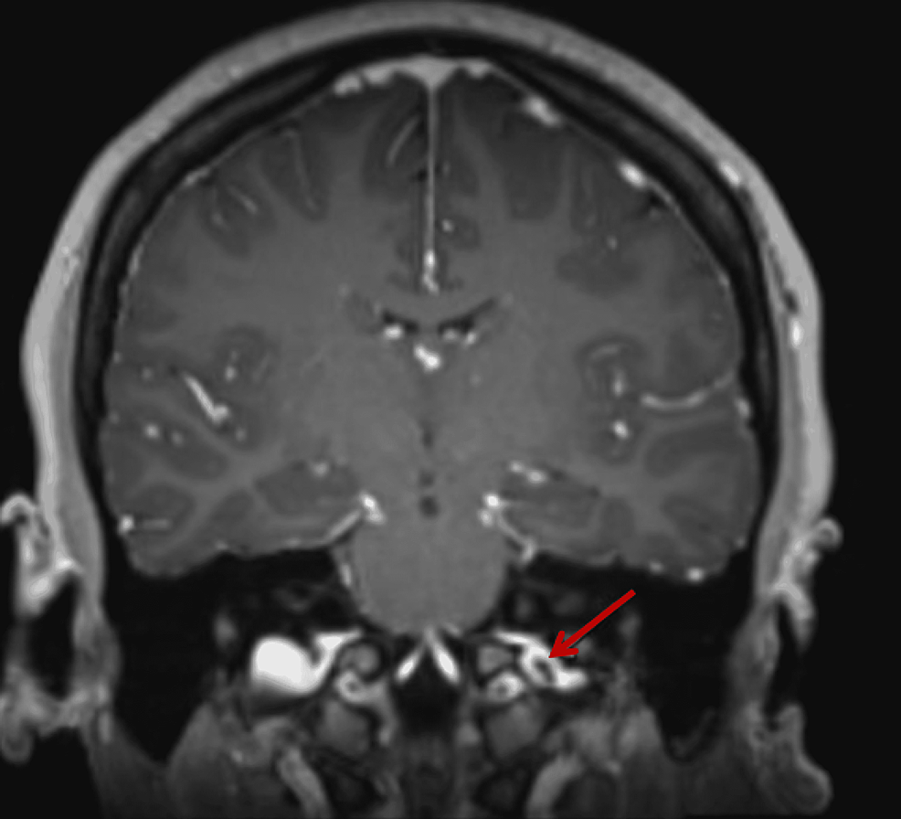 internal jugular vein brain