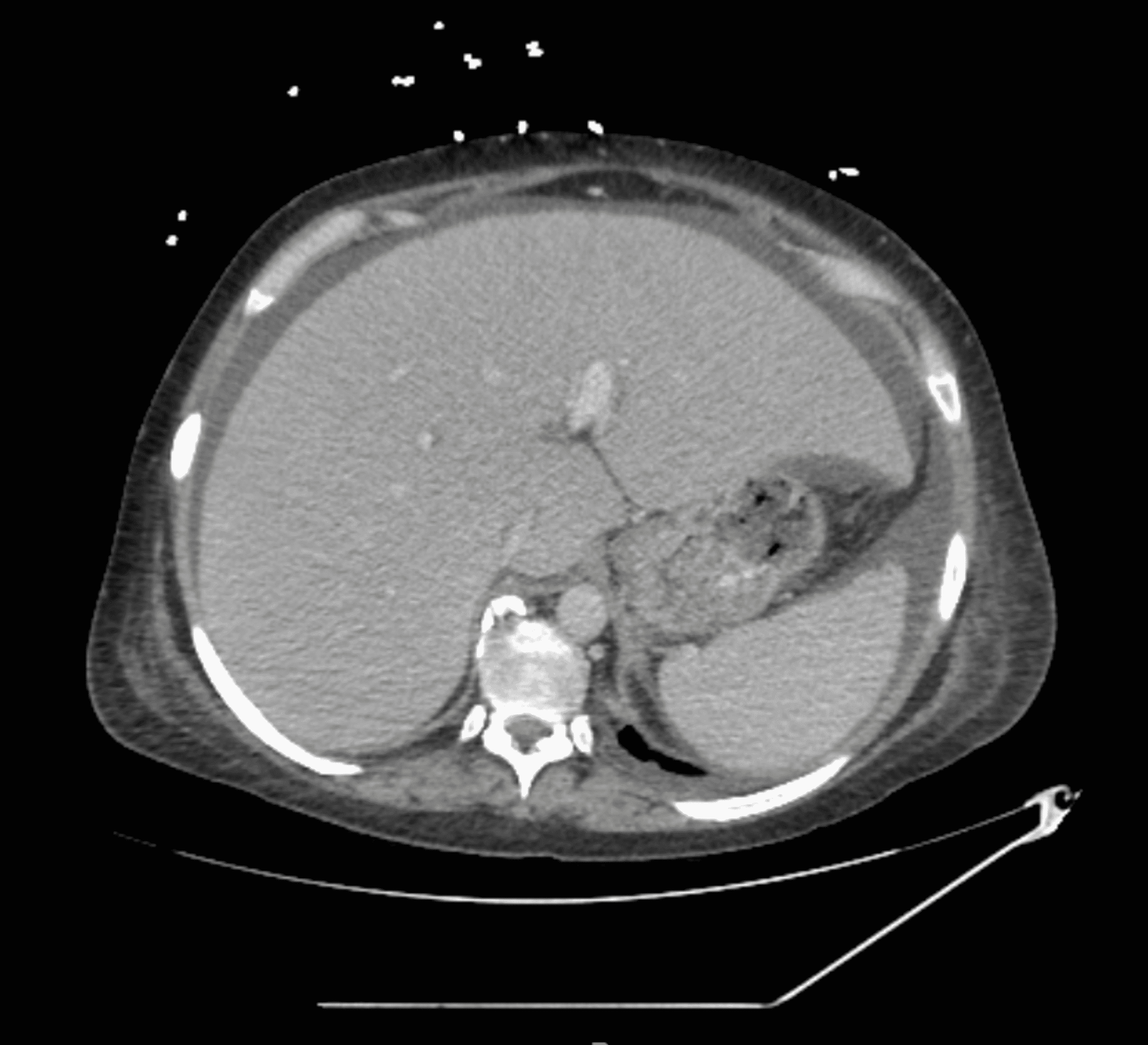 A Case Of Adult-onset Iga Vasculitis In A Cirrhotic Patient 