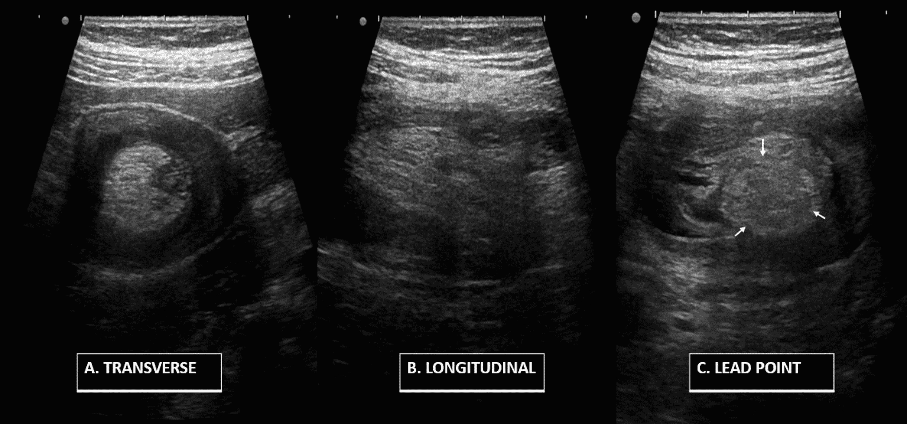 Cureus Ileal Lipoma As A Leading Point Of Ileocolic Intussusception In Adult Patient 