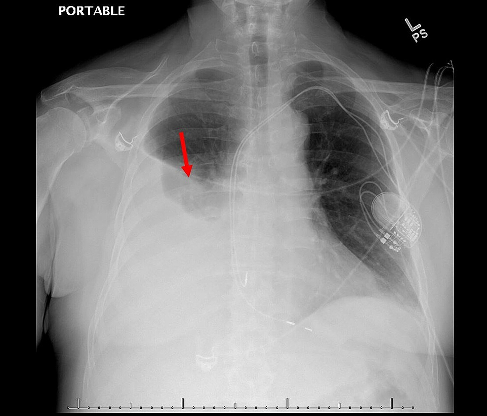 Large Unilateral Pleural Effusion with Pacemakerassociated Post