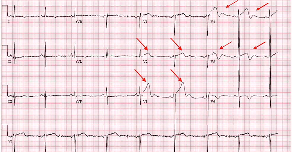 Cureus | Wellens' Syndrome: A Sign of Impending Myocardial Infarction