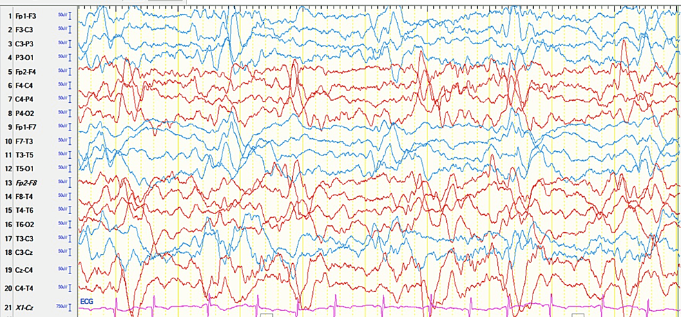 Cureus, Brainstem and Spinal Arachnoiditis Ossificans Associated With  Neurocysticercosis: A Case Report