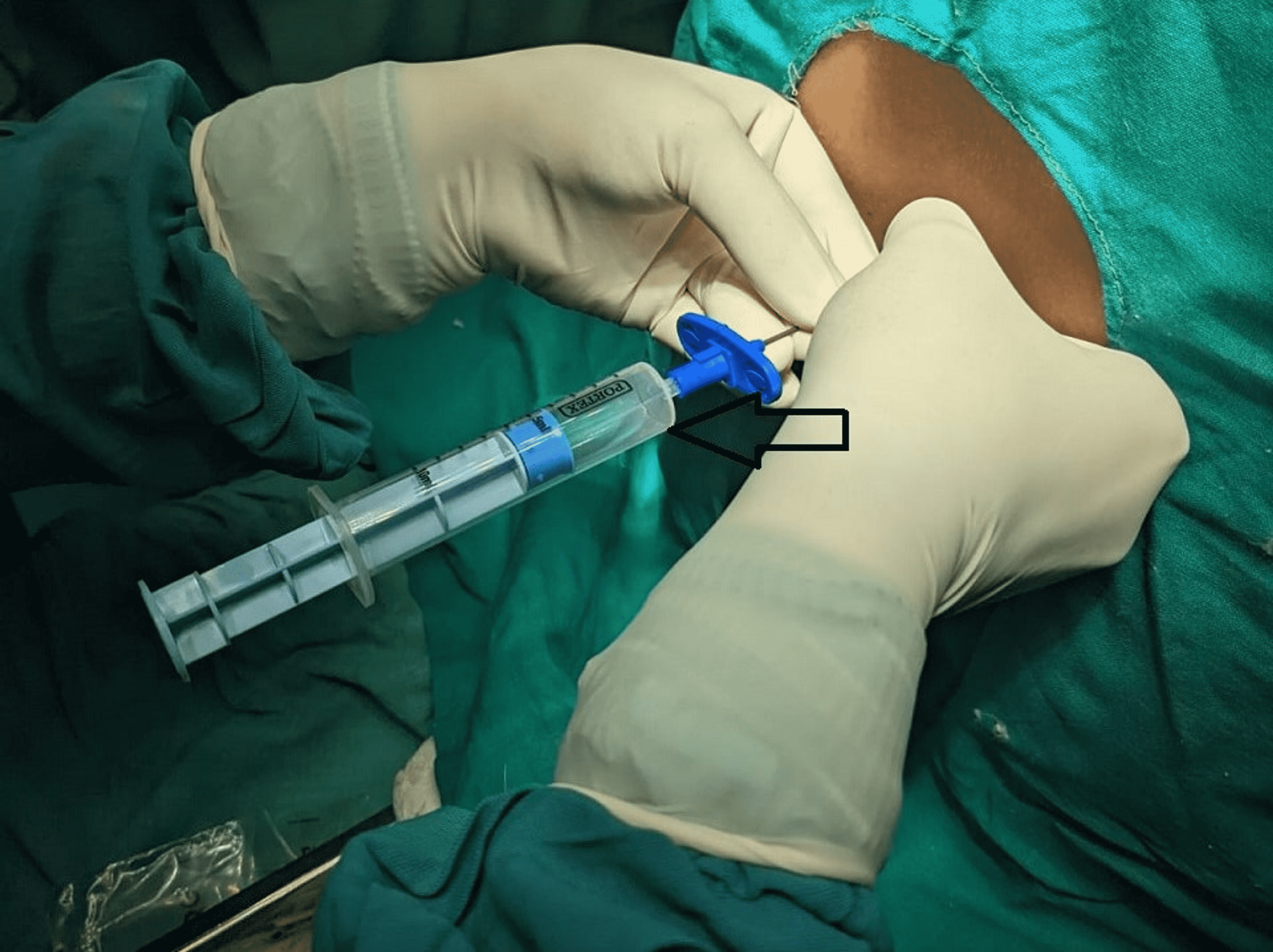 Cureus Continuous Spinal Anesthesia Technique After Accidental Dural