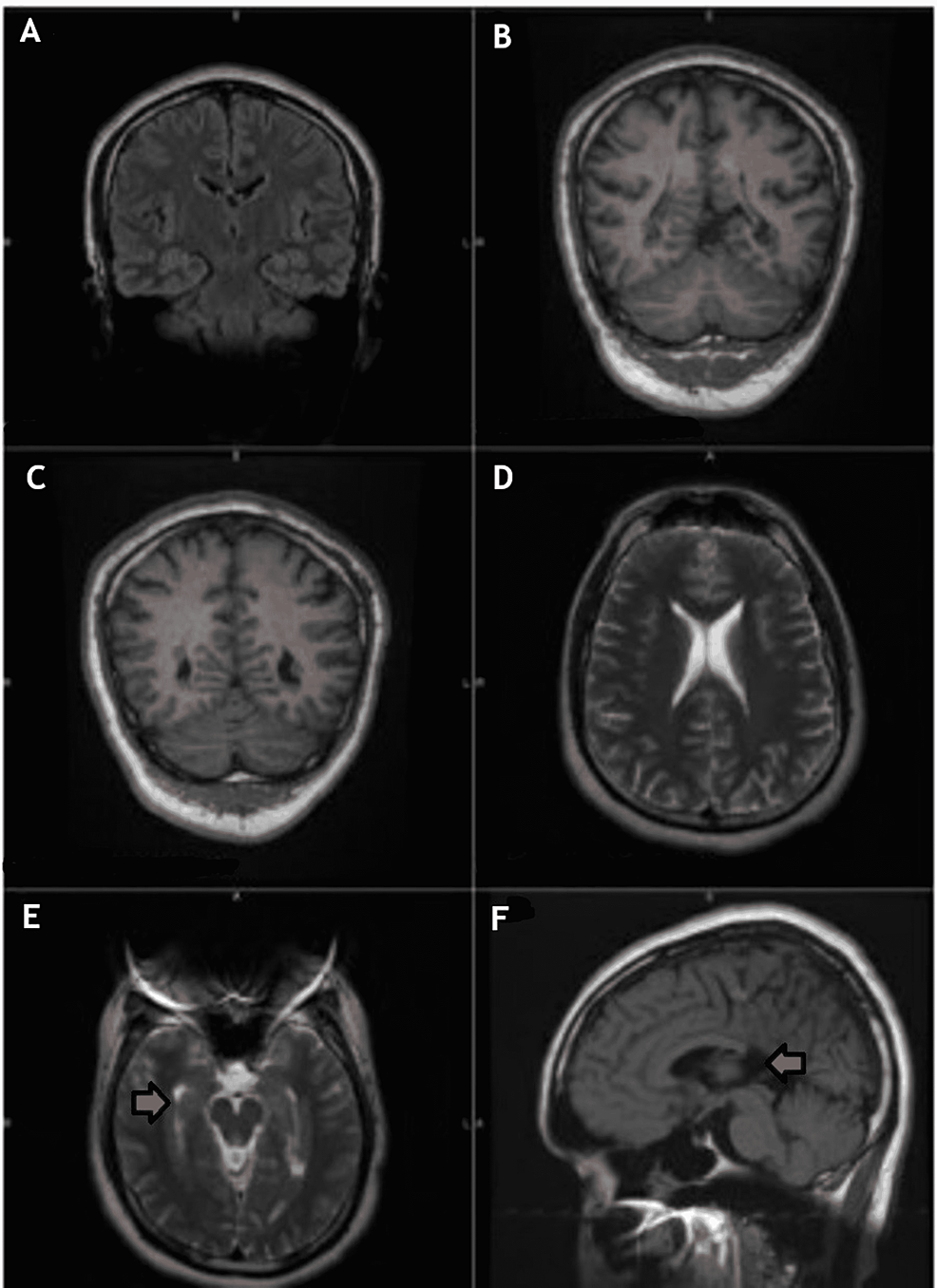 Rubinstein-Taybi syndrome with agenesis of corpus callosum