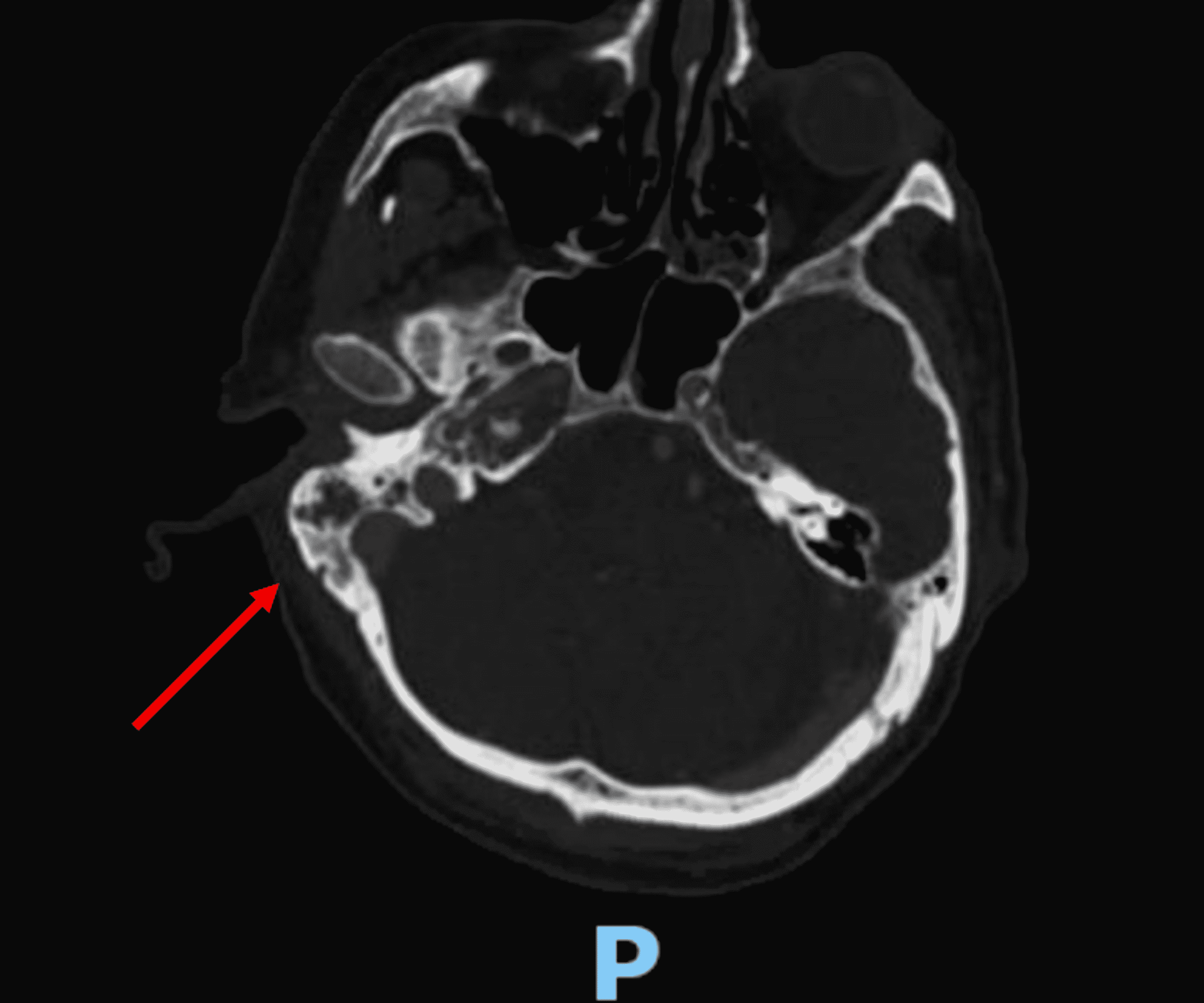 Malignant Otitis Externa Radiology