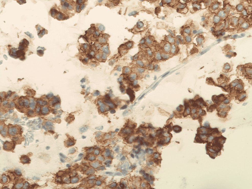 Immunohistochemical-staining-showing-strongly-CD117-positive-tumor