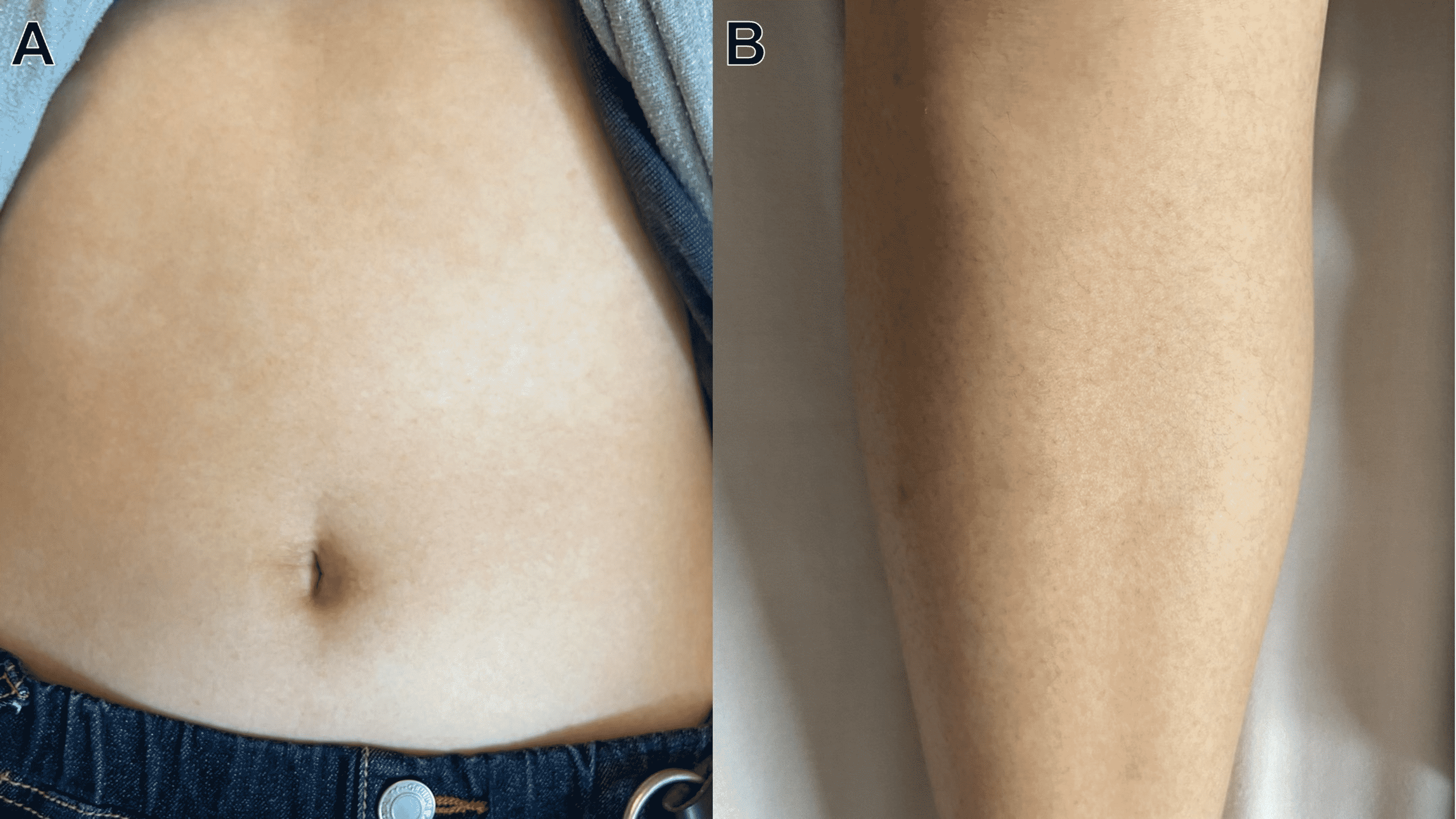 Cureus AdultOnset Still’s Disease With Severe Hyperferritinemia and