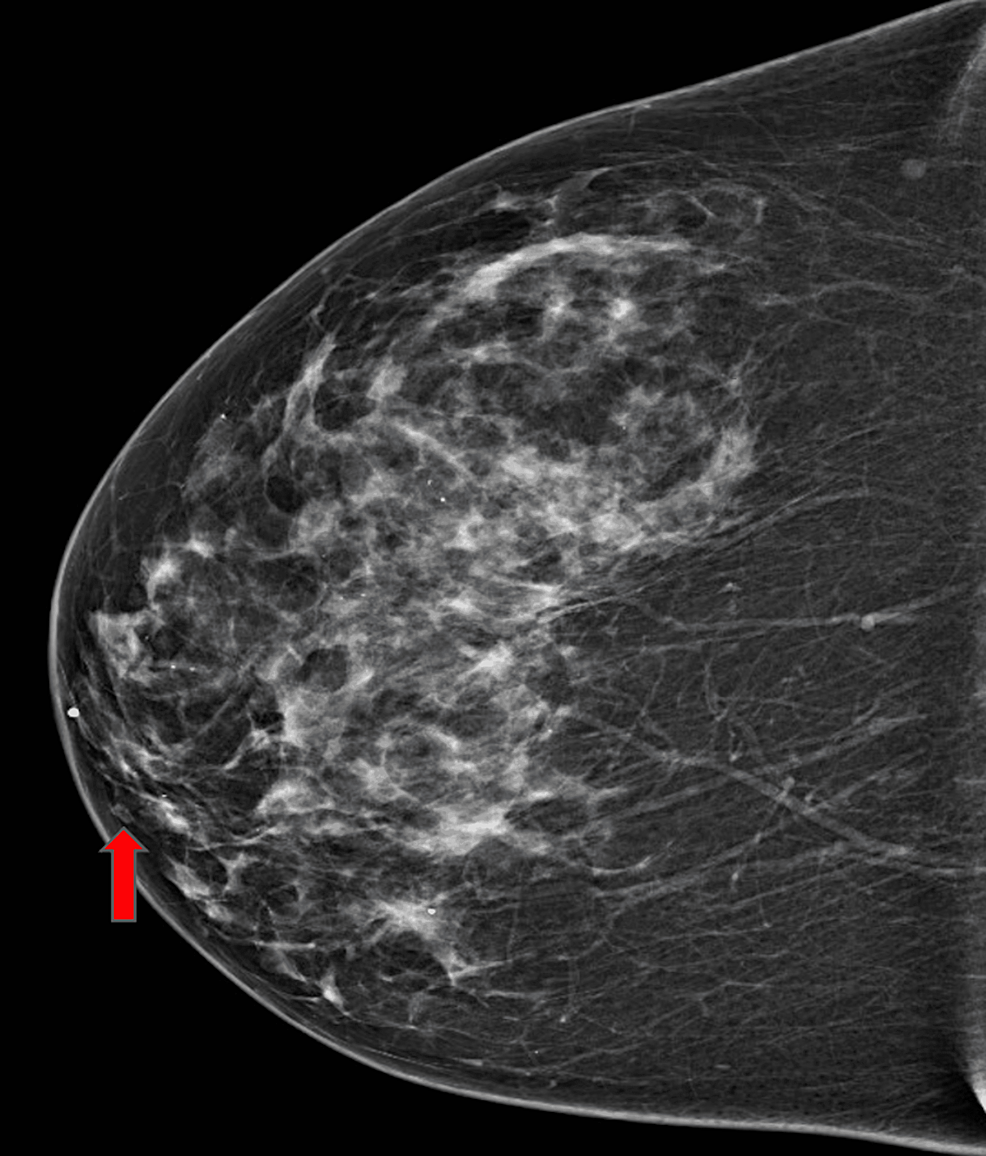 Cureus | Adenosquamous Carcinoma of the Breast: Case Report and Literature  Review