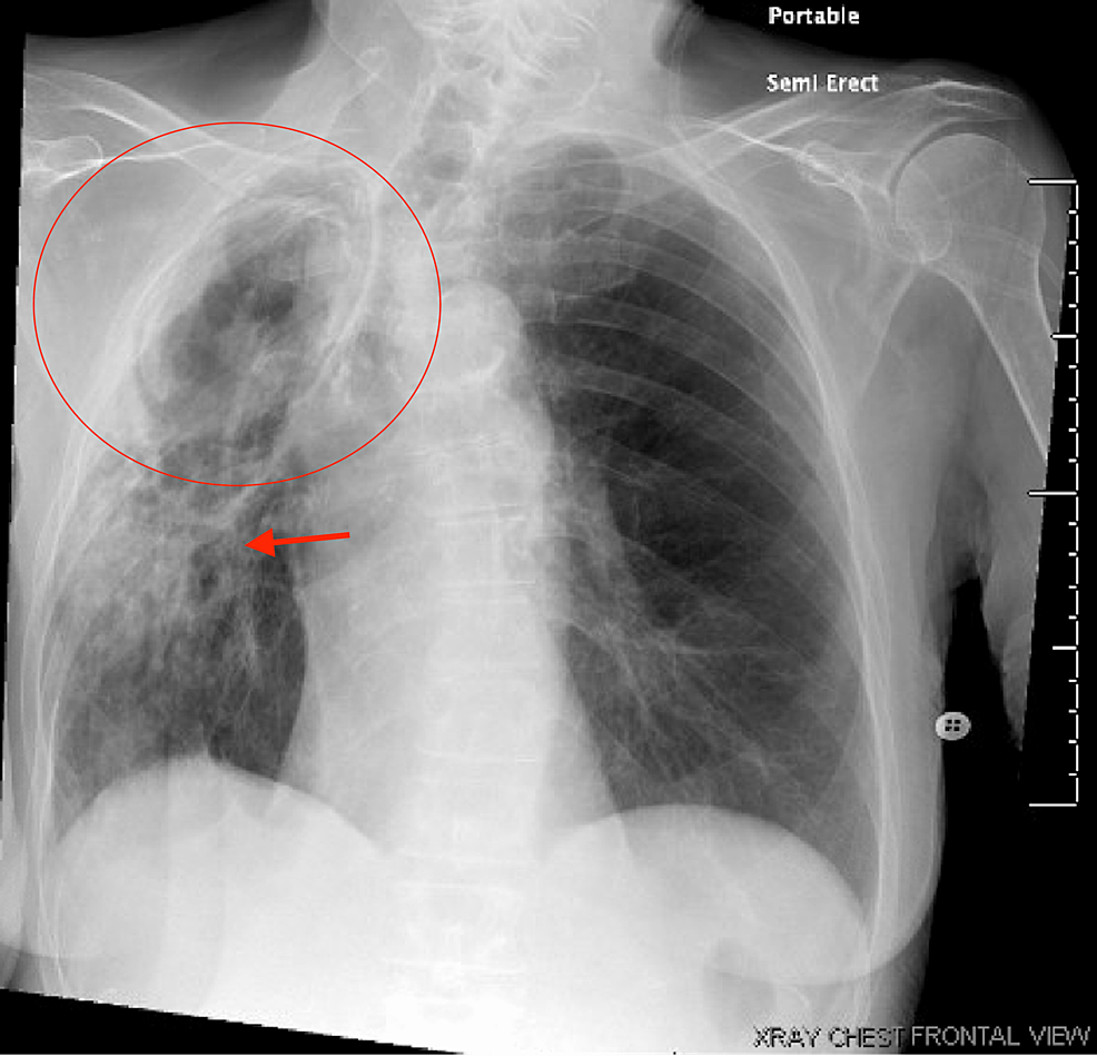 Chest-radiograph-showing-cavitary-lesion-in-the-right-upper-lung-lobe-(circle)-and-new-focal-opacity-(red-arrow).