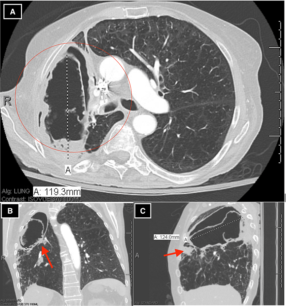 CT-images-of-chronic-invasive-pulmonary-aspergillosis.-Thick-walled-cavity-in-the-right-upper-lung-lobe-(circle)-with-new-internal-round-debris,-thick-rind,-internal-papillary-projections,-cauliflower-like-lobulations,-pericavitary-consolidation-and-possible-formation-of-a-fungal-ball-within-the-cavity-(red-arrows)-present-in-(A)-axial-view,-(B)-coronal-view,-and-(C)-sagittal-view.-