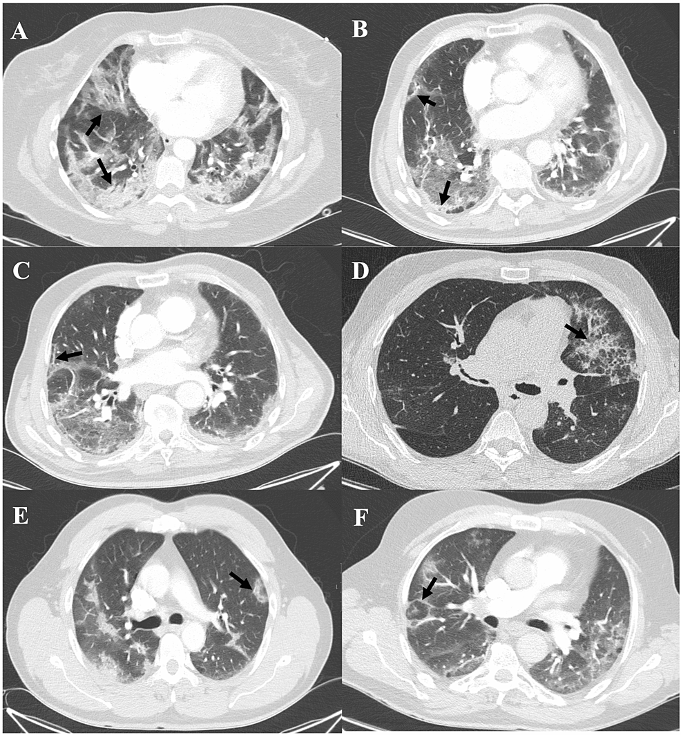 CT-features-of-organising-pneumonia-in-COVID-19-pneumonia-patients