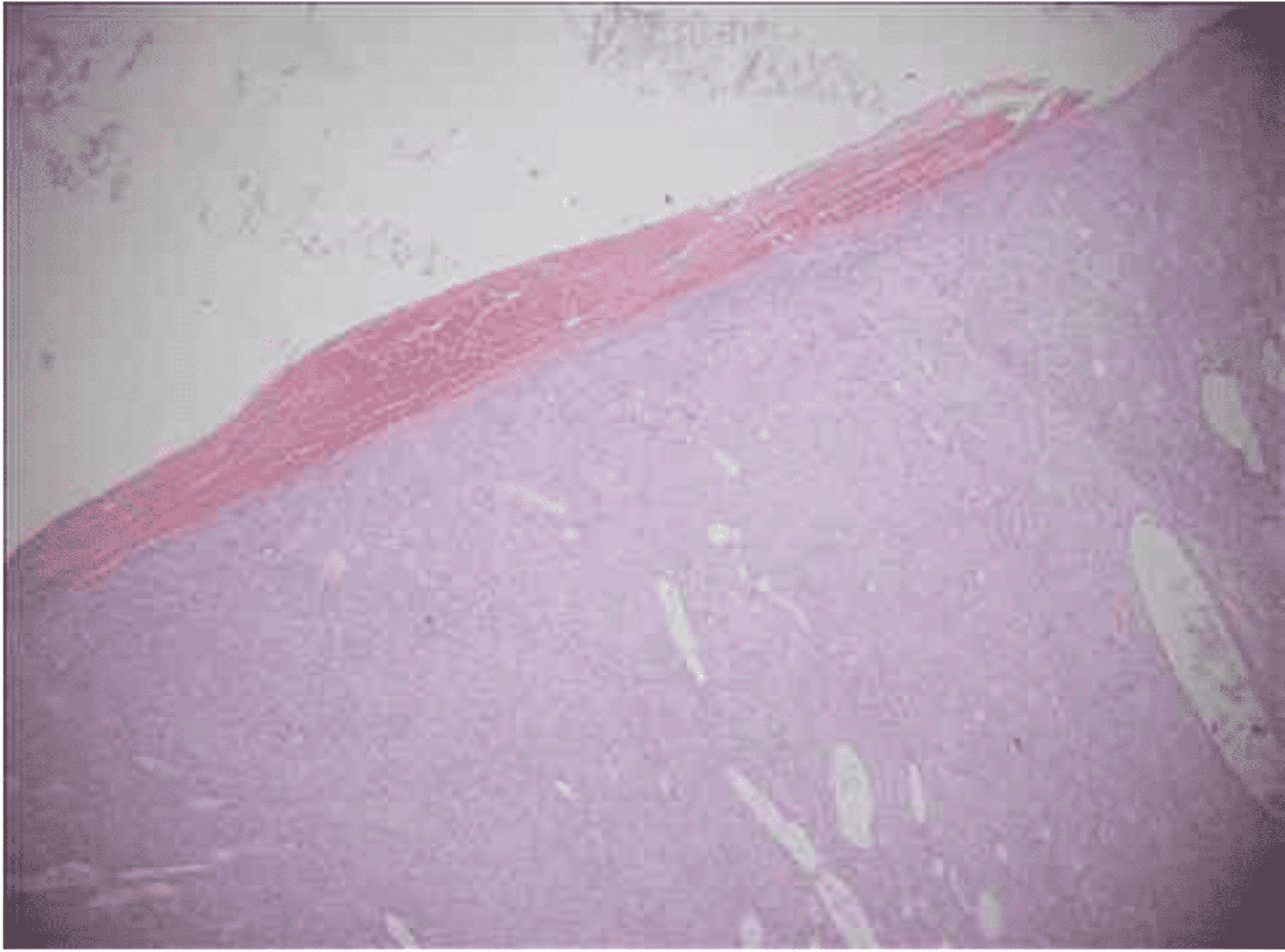 Spindle Cell Carcinoma in the Breast A Case Report Cureus