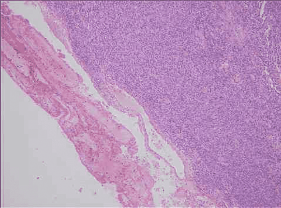 Spindle Cell Carcinoma in the Breast A Case Report Cureus