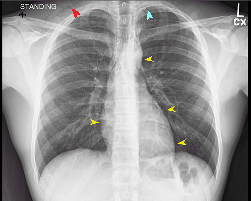 AP-chest-X-ray