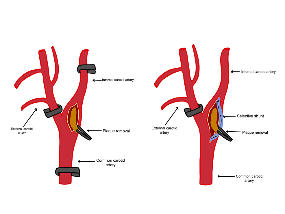 Cross-clamping-of-the-carotid-artery.