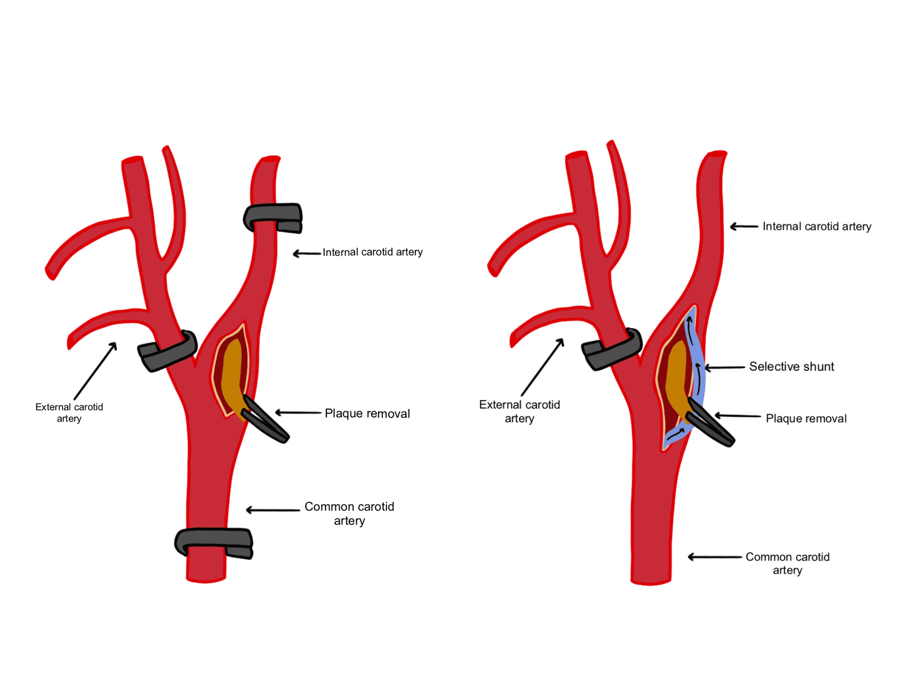 Cureus Carotid Endarterectomy Surgeries A Multimodality