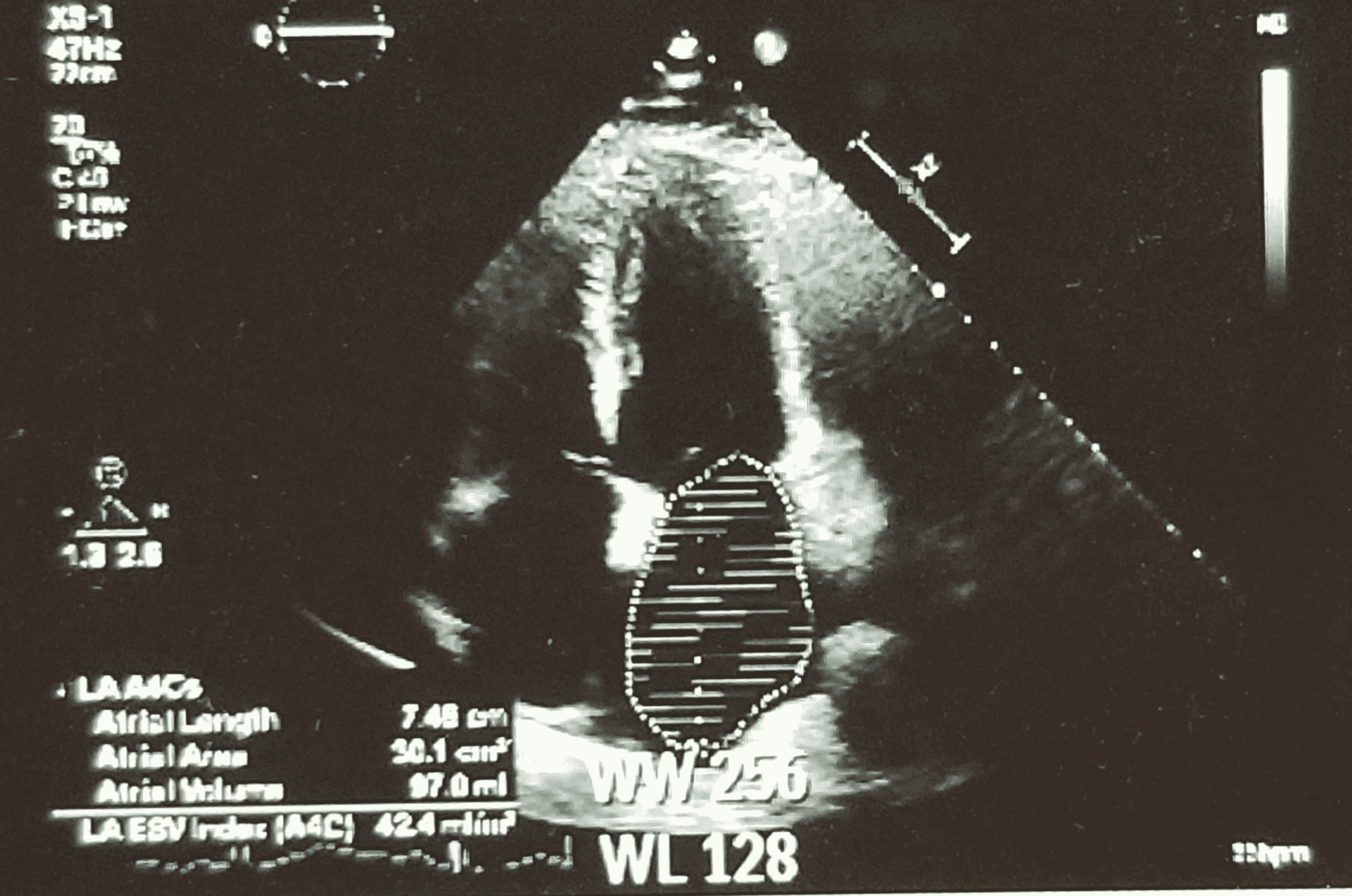 Cureus | Cardiovascular Remodeling in Chronic Mineralocorticoid Excess |  Media