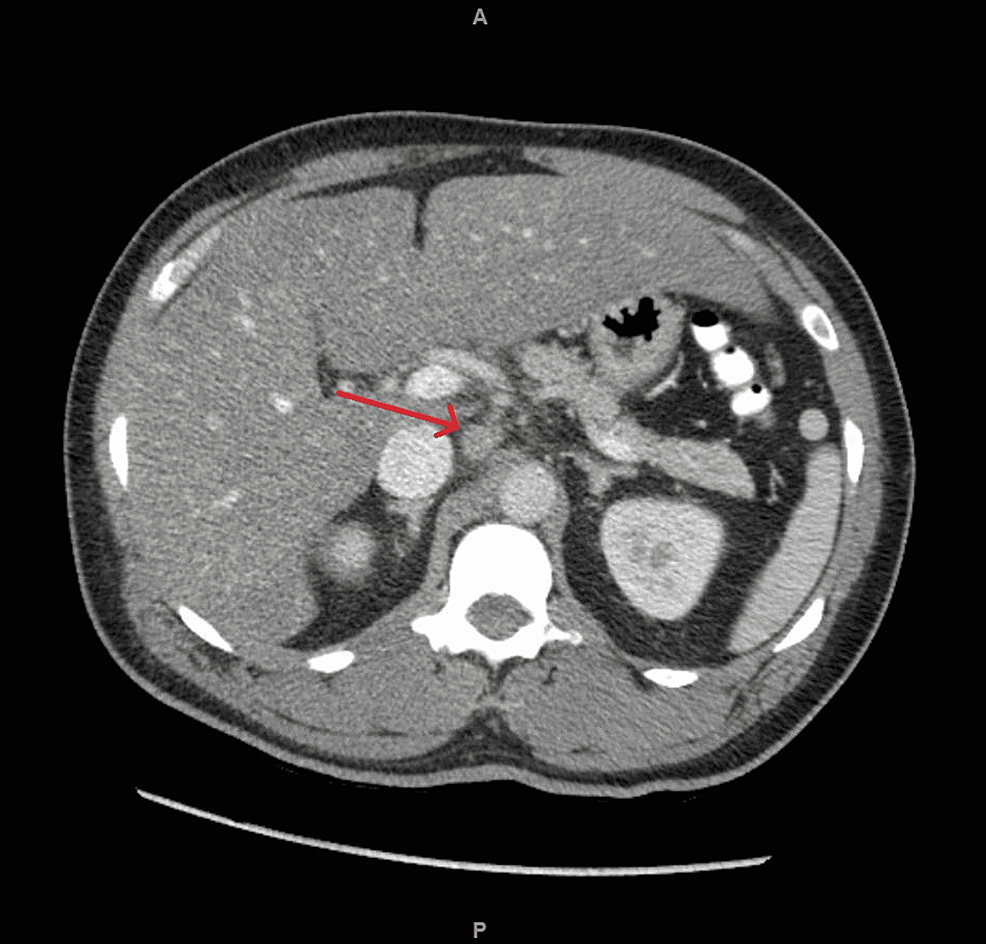 Computed-tomography-of-abdomen-and-pelvis-showing-enlarged-lymph-nodes-(red-arrow)-in-upper-retroperitoneum-and-gastric-hepatic-ligament