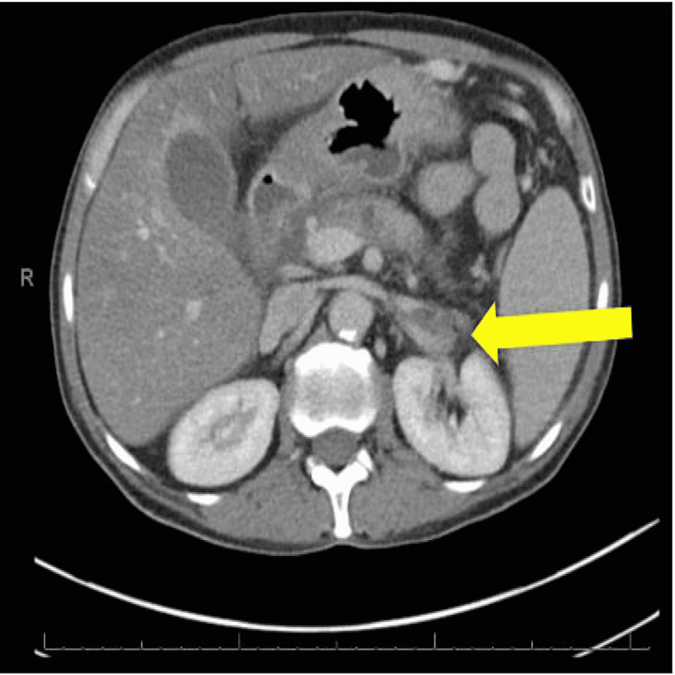 Splenic Vein Thrombosis: A Case Series Of Consequential Chronic ...