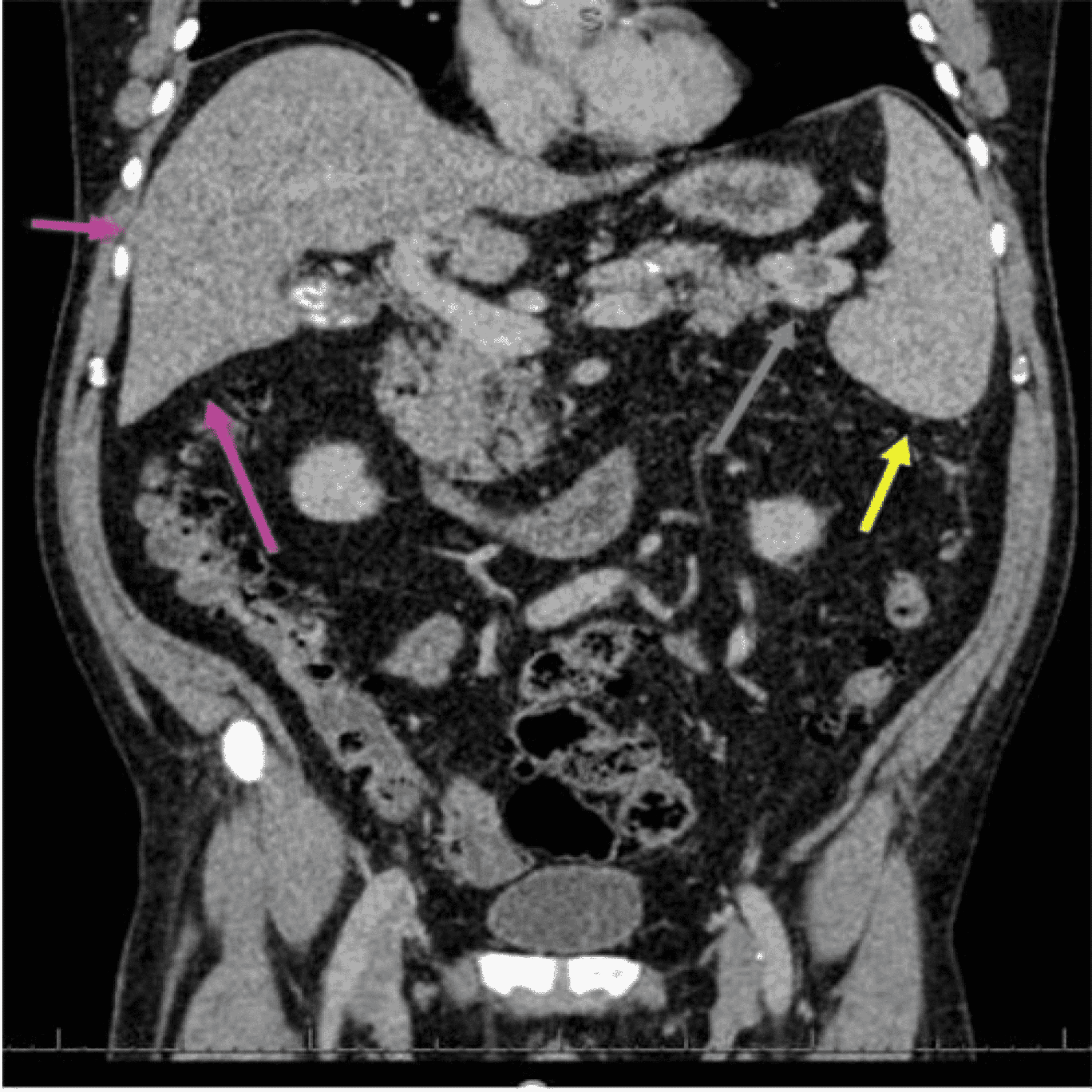 Cureus | Splenic Vein Thrombosis: A Case Series Of Consequential ...