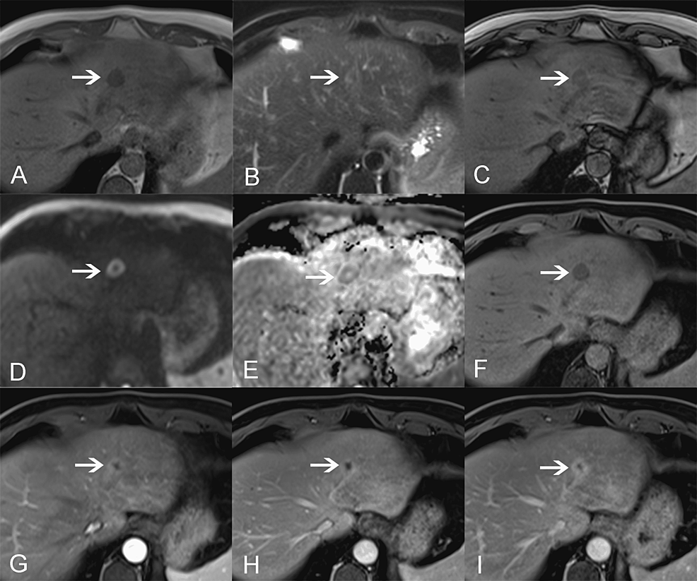 Magnetic Resonance Imaging Findings Of An Intrahepatic Bile Duct Adenoma A Case Report Cureus