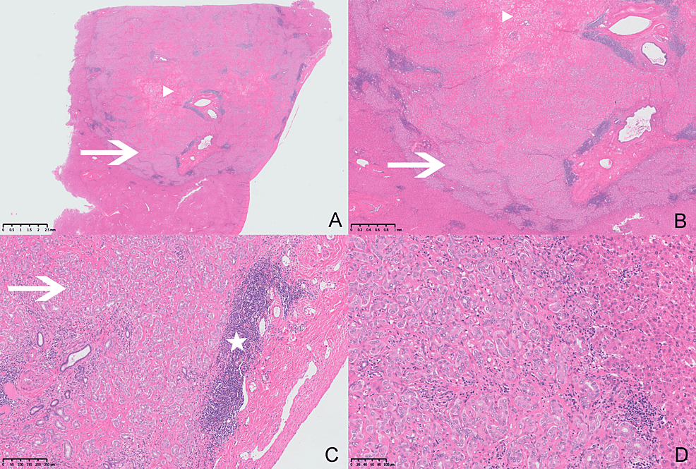 Cureus Magnetic Resonance Imaging Findings Of An Intrahepatic Bile Duct Adenoma A Case Report