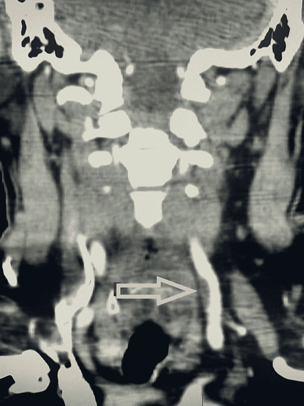 CTA-of-the-same-patient-shown-in-Figure-2,-confirming-the-presence-of-thrombus