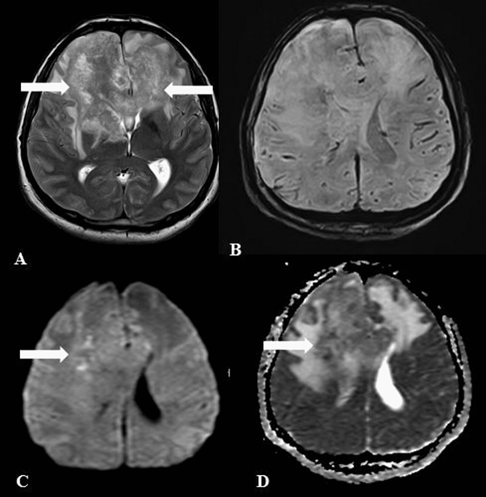 Cureus | Giant Central Nervous System Aspergilloma Mimicking Butterfly ...