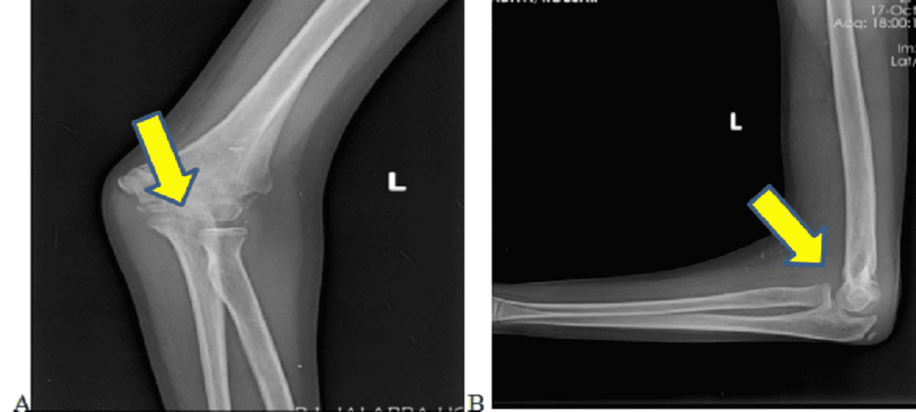 Cureus Surgical Management of Flexion Type Supracondylar Humeral
