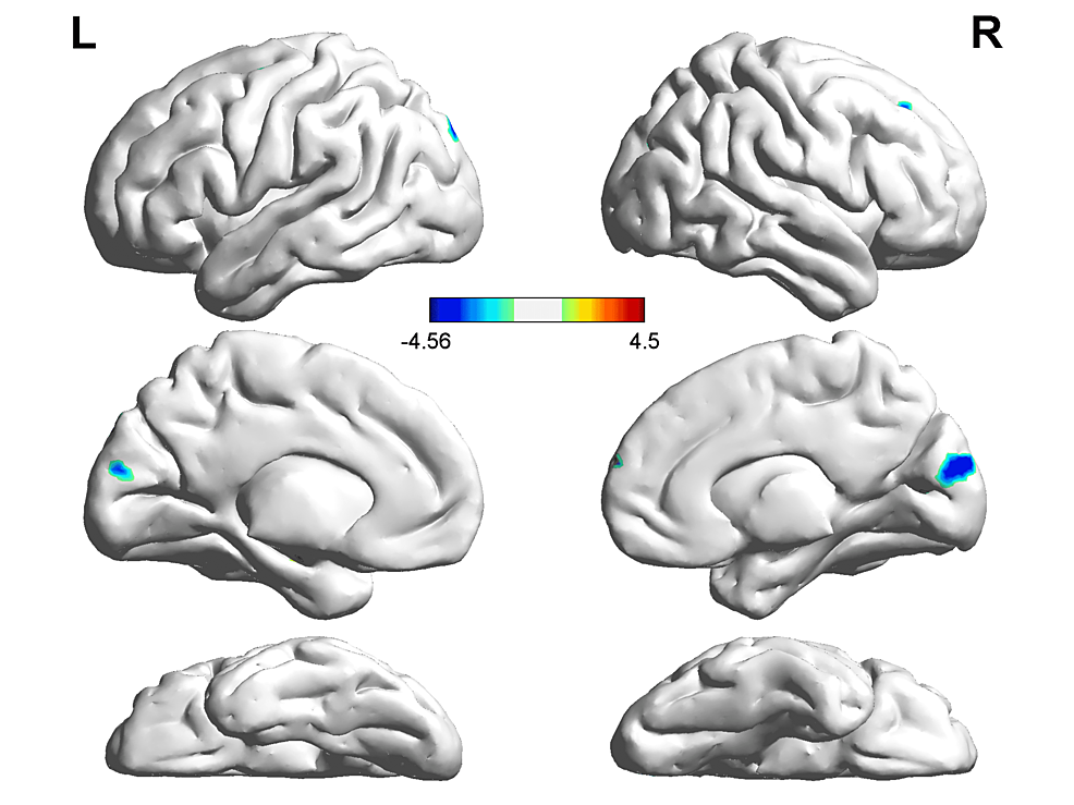 Cureus | Alterations of Regional Homogeneity in Parkinson’s Disease: A ...