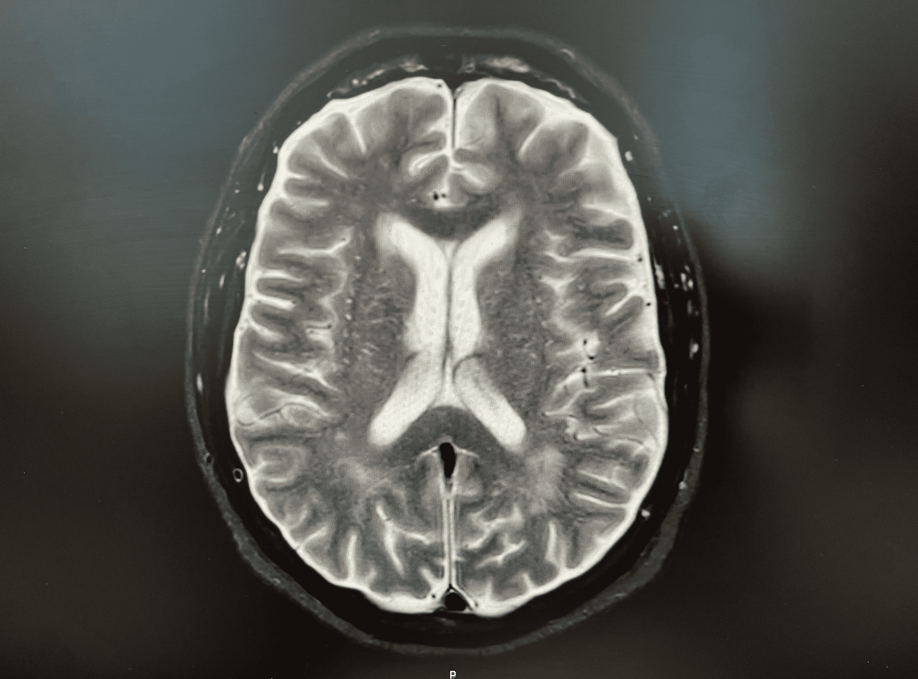 Cureus | The Relationship Between Exacerbation of Pachymeningitis and ...