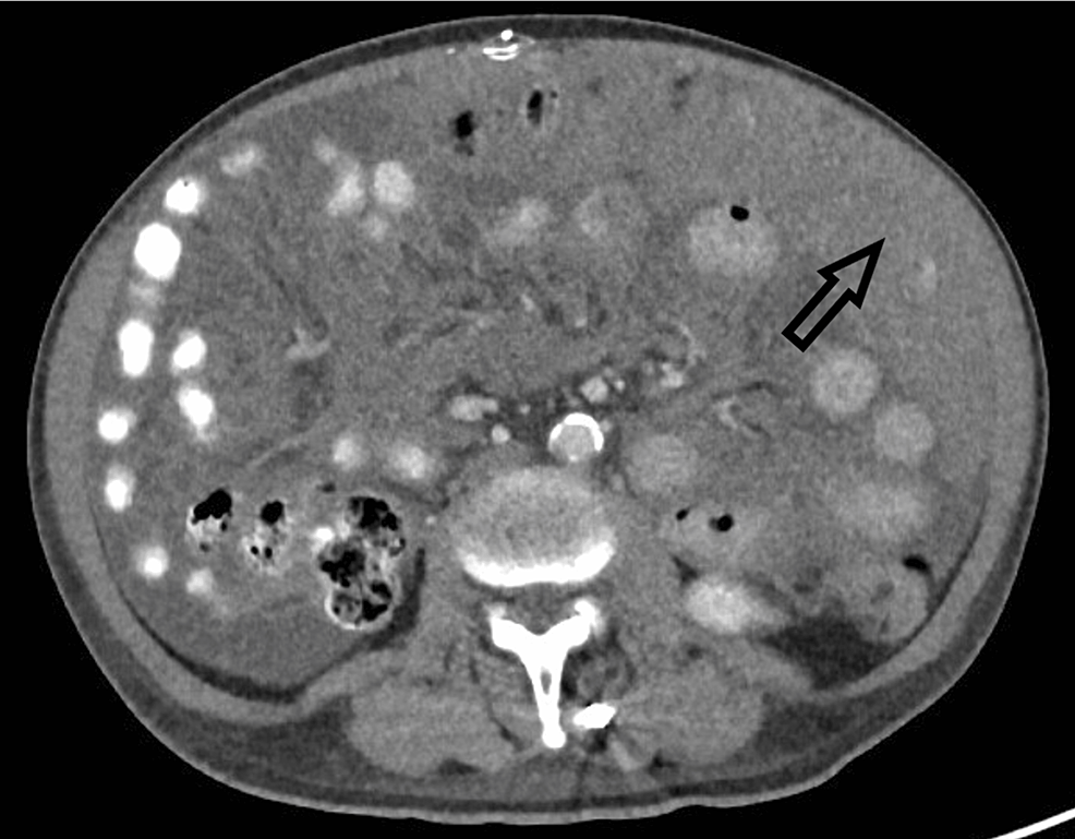 cureus-malignant-peritoneal-mesothelioma-presenting-with-high-protein