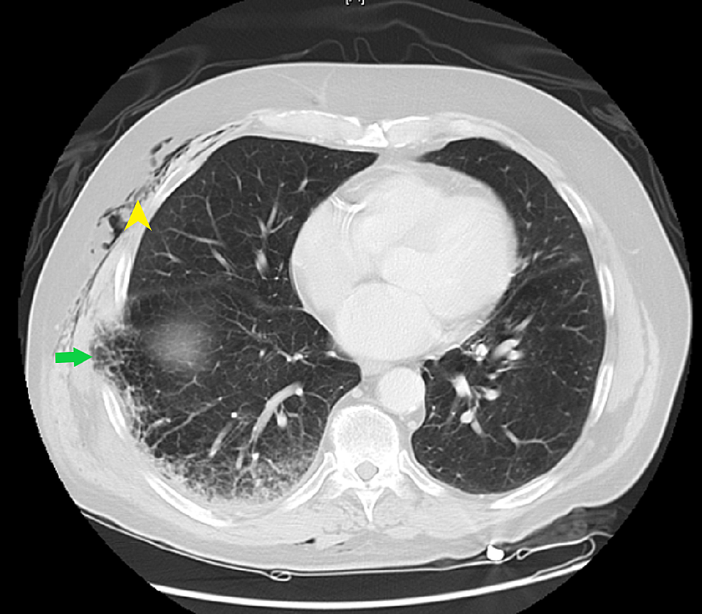 Cureus Spontaneous Lung Herniation Leading To Extensive Subcutaneous