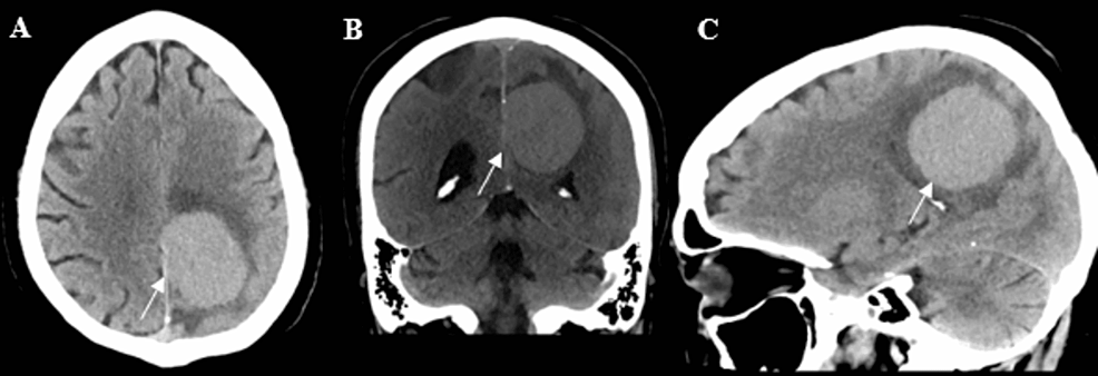Initial-CT-Head-imaging-with-axial-(A),-coronal-(B),-and-sagittal-(C)-views.