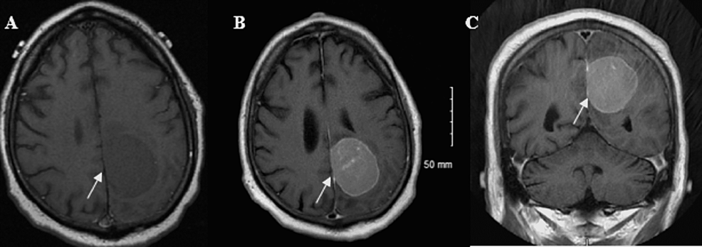 Initial-MRI-Brain-with-and-without-contrast.