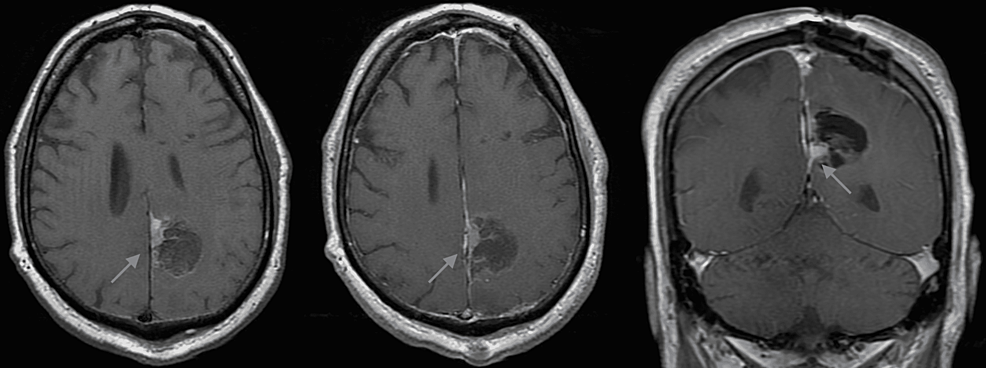 Postoperative-non-contrasted-(A)-and-contrast-enhanced-axial-(B)-and-coronal-(C)-images.