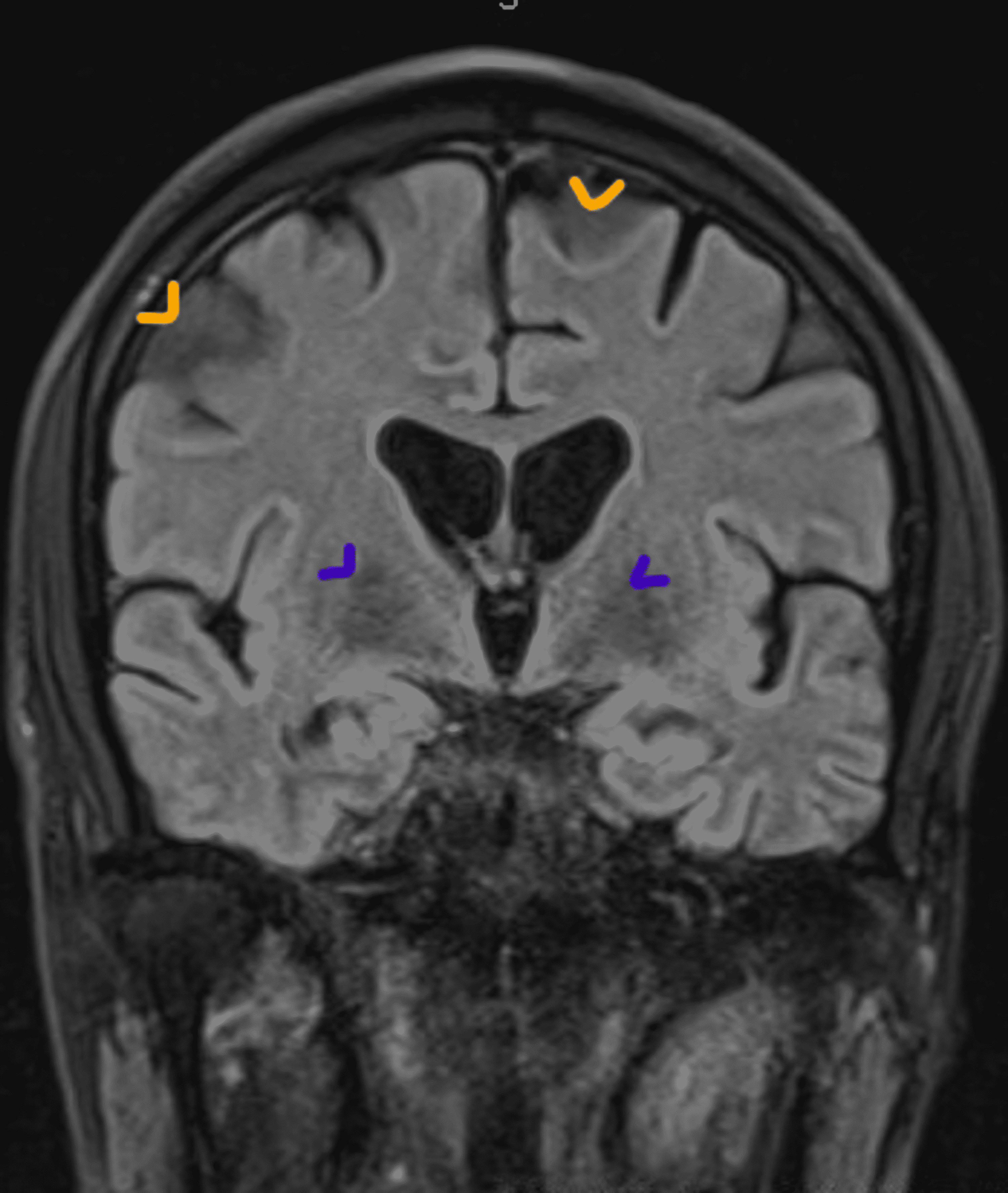 Cureus | Frontotemporal Dementia: Dilemma in Discrimination From