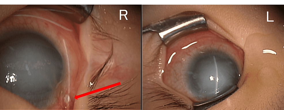 Pictures-of-anterior-segment-at-the-tube-covering-procedure-under-general-anesthesia.