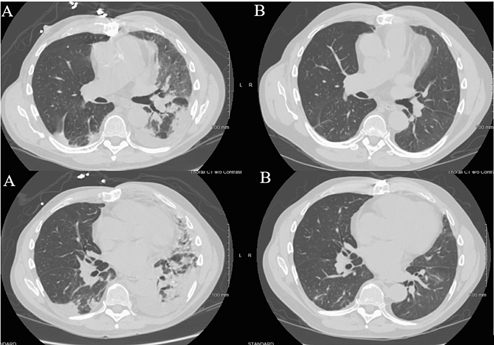 Chest-CT-upon-presentation-(A)-shows-left-worse-than-right-consolidative-and-ground-glass-infiltrates-and-upon-follow-up-at-six-weeks-(B)-shows-near-complete-resolution-of-the-infiltrates.