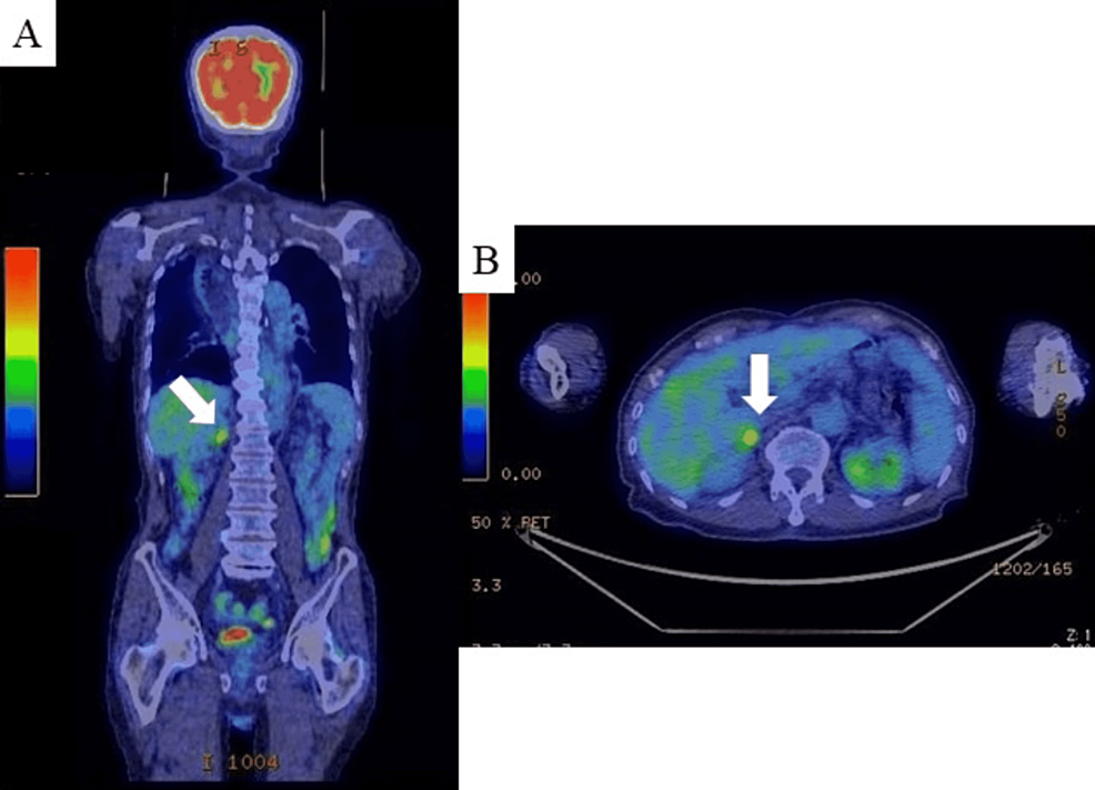 FDG-positron-emission-tomography-computed-tomography-after-one-year-surveillance-period.