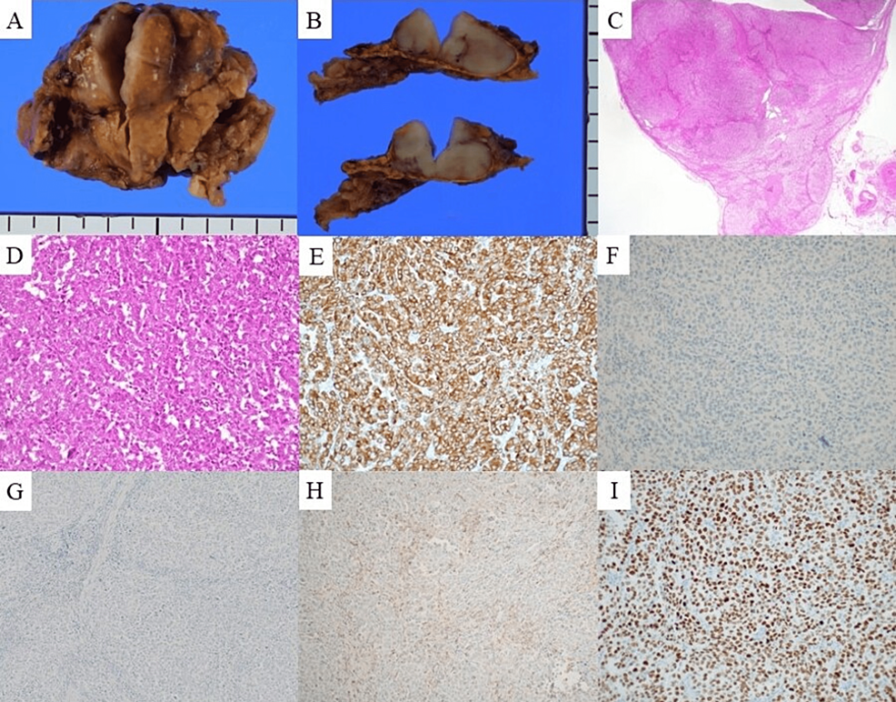Pathological-findings-of-the-resected-sample-of-adrenal-gland.