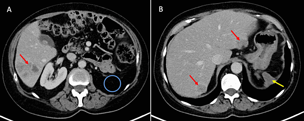 Portal-phase-CT-of-the-abdomen-prior-to-SIRT-therapy.