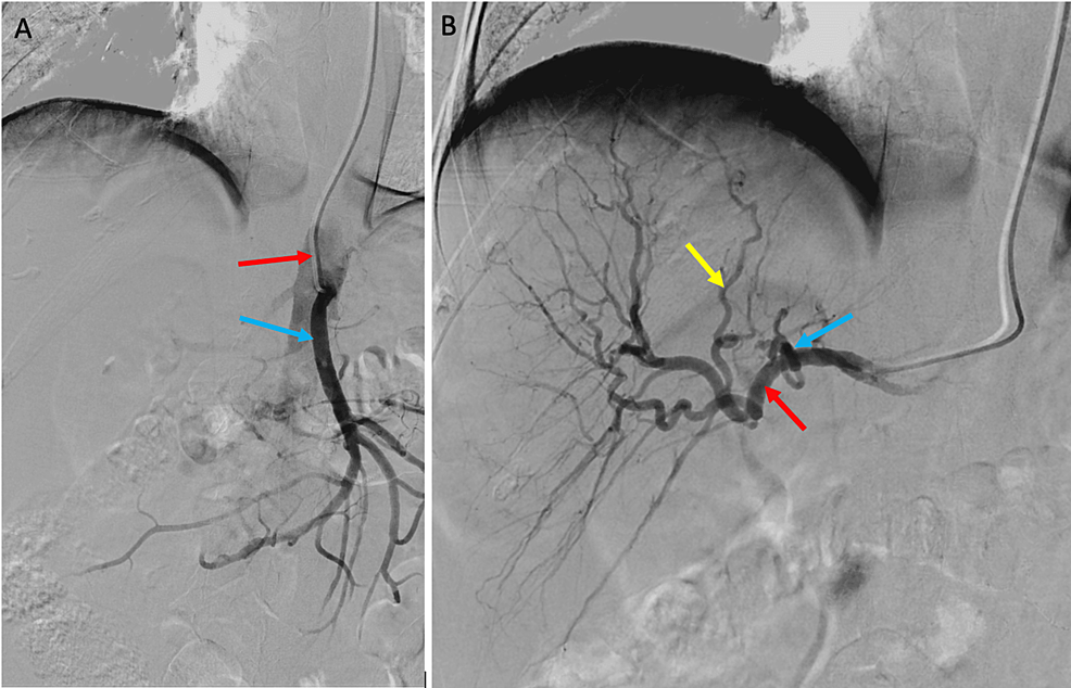 Fluoroscopic-image-(digital-subtraction-angiography)-showing-contrast-injection-through-the-arterial-catheter.