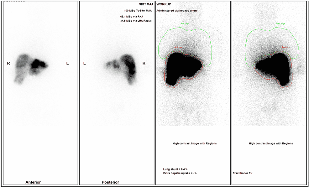 SPECT-scan-planar-images-following-99mTc-MAA-injection.