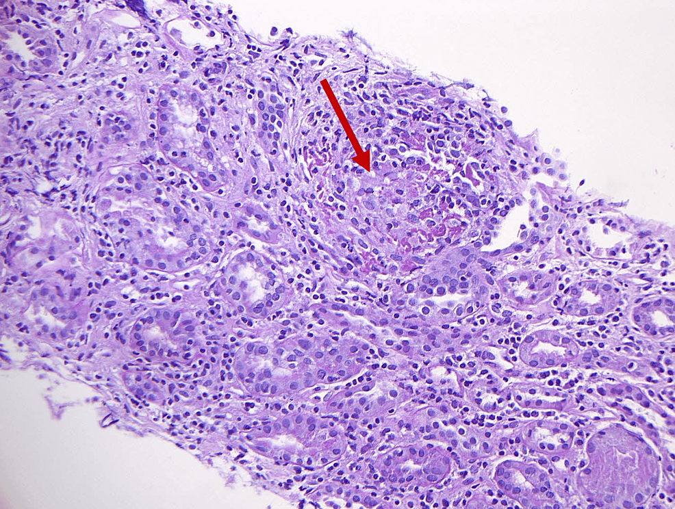 Cureus | A Young Man With Acute Kidney Injury and Uveitis: An Unusual  Presentation and Case Report