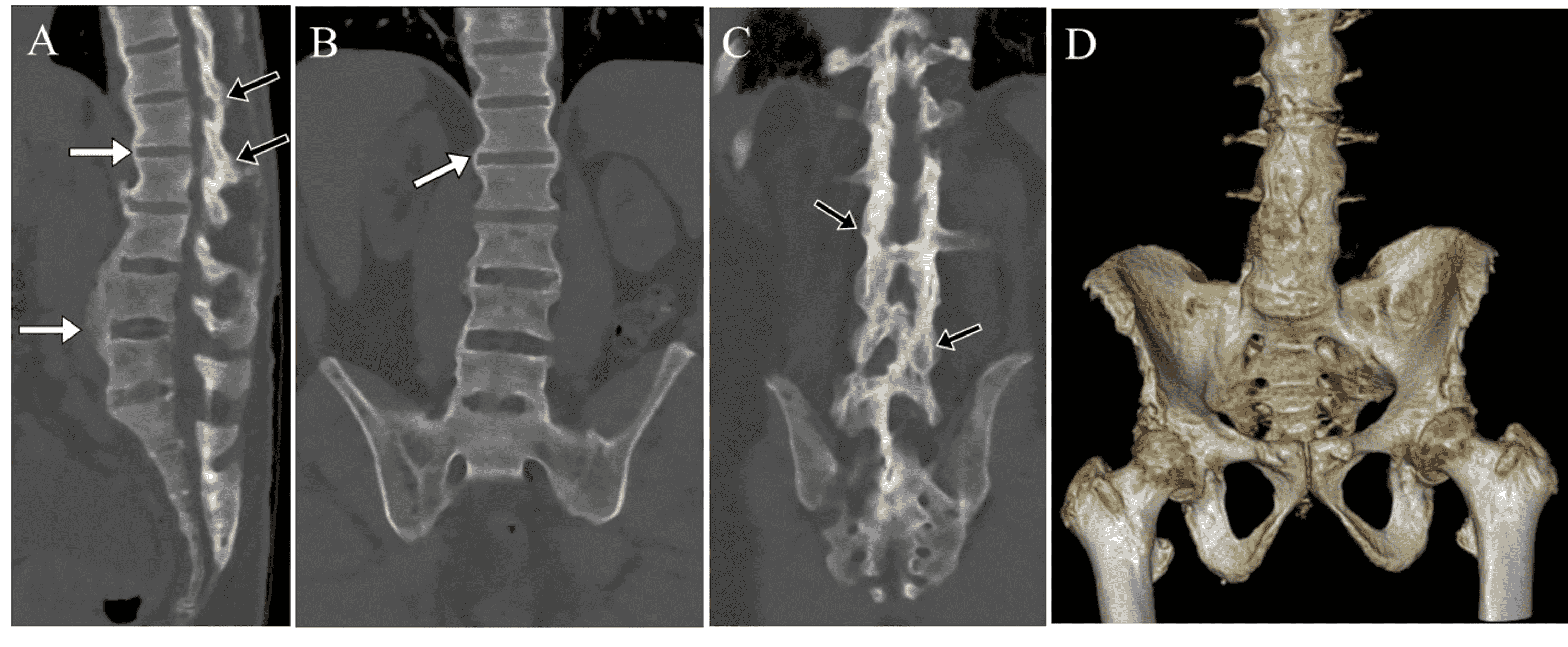 x ray hindfoot fusion