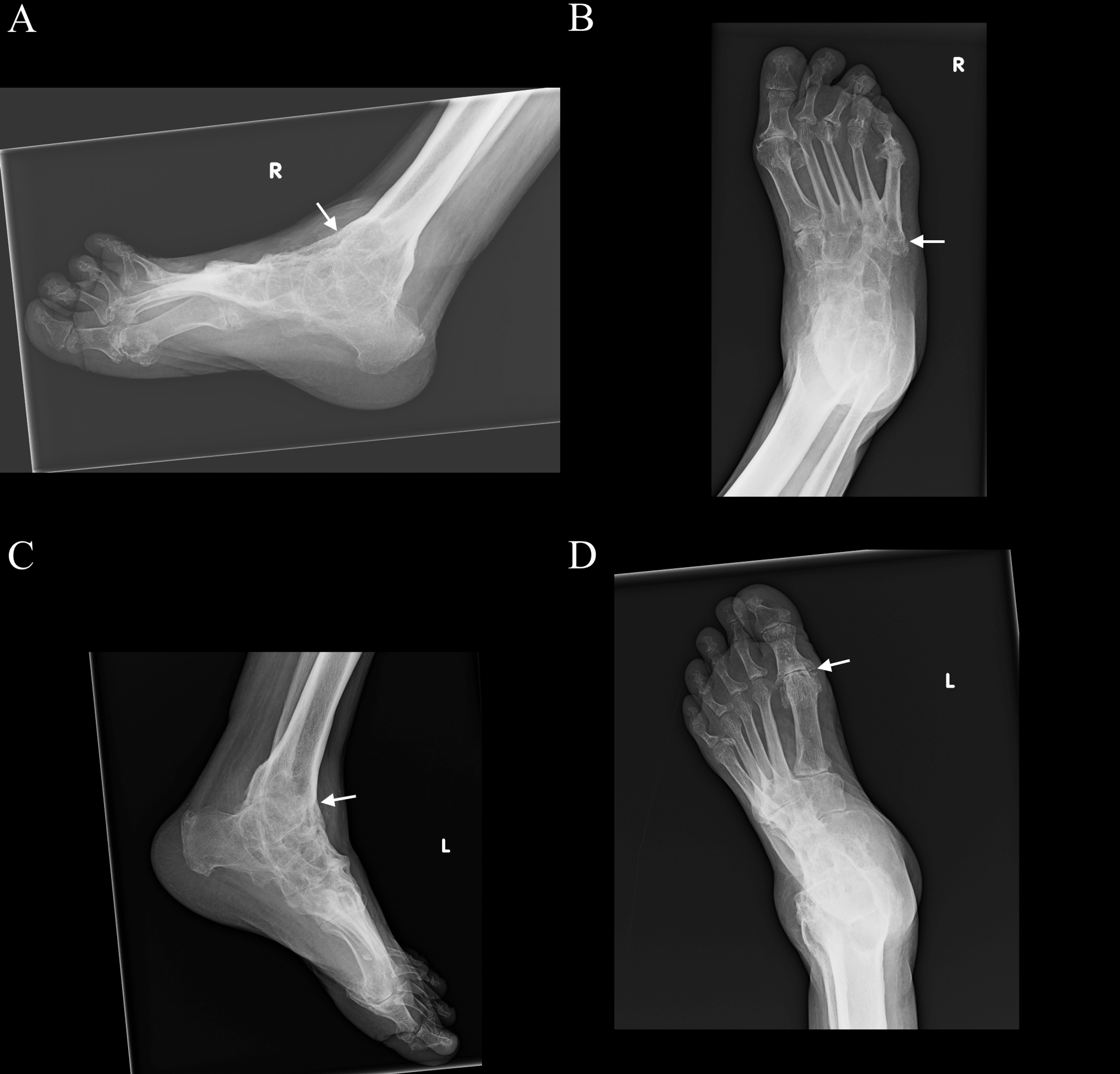 x ray hindfoot fusion