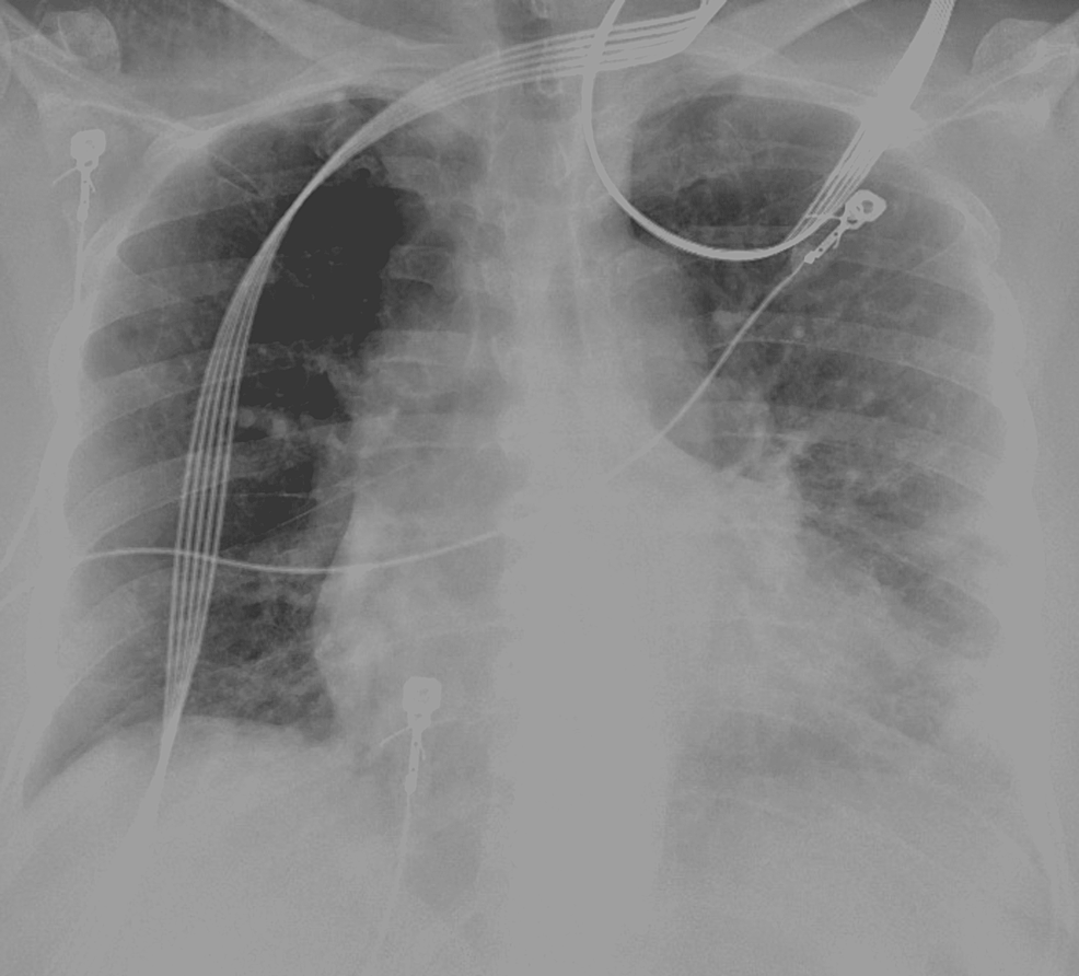 Radiografía de tórax al ingreso que muestra infiltrados pulmonares inferiores izquierdos en parches compatibles con neumonía