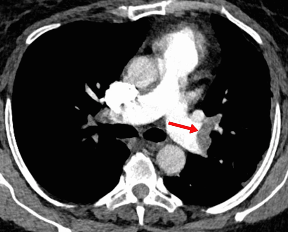 Angiografía por TC del tórax que muestra un trombo en la arteria pulmonar principal izquierda